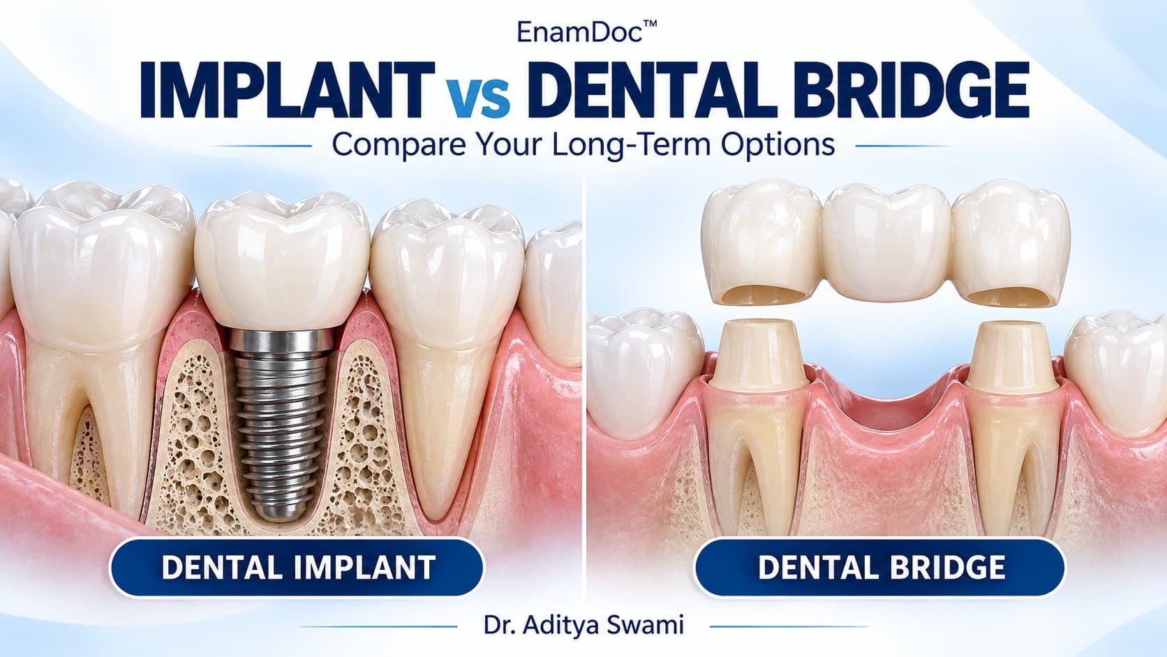 Side-by-side illustrations of a dental implant in jawbone and a three-unit bridge above two prepared supporting teeth.