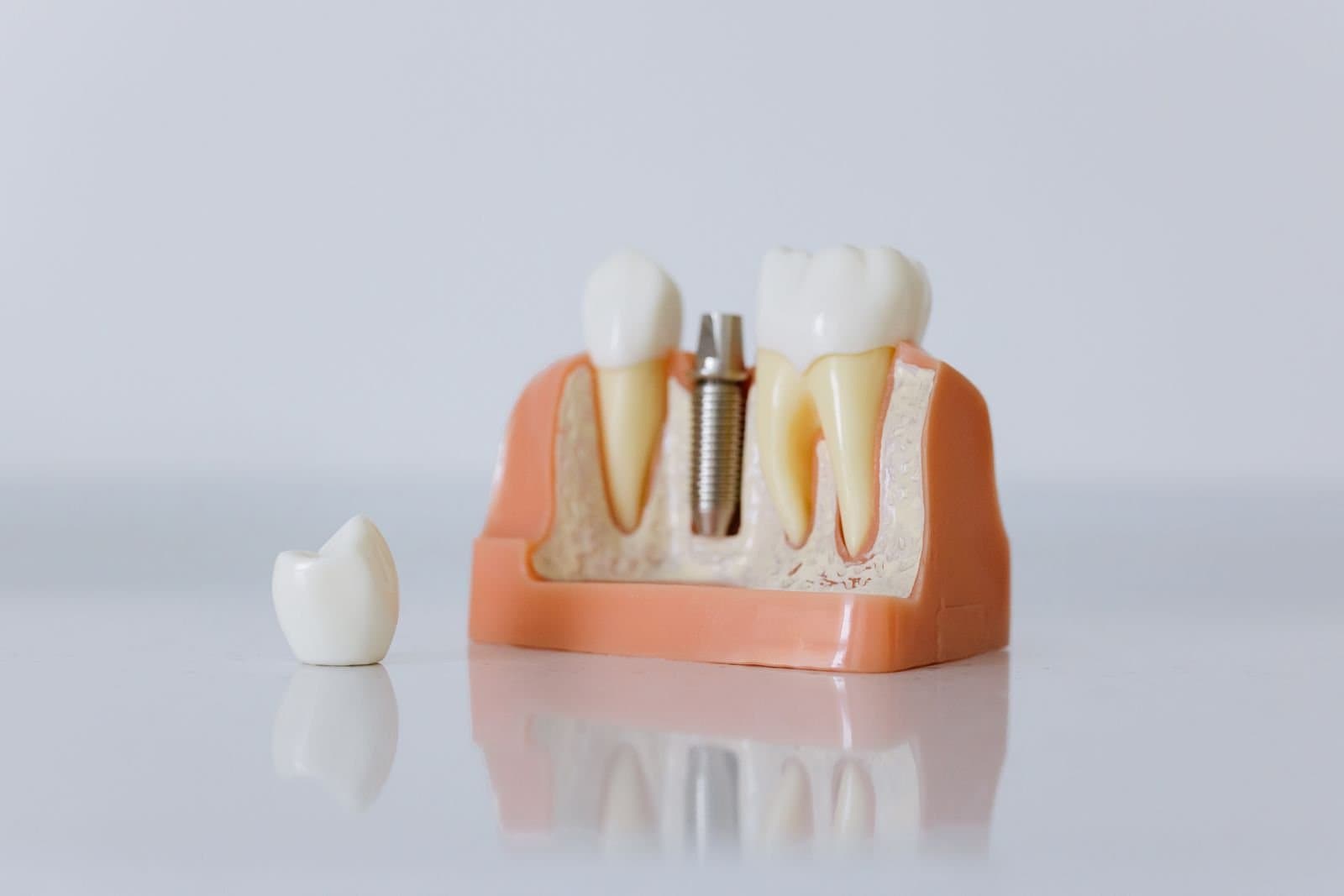 Close-up of a dental implant model showing the titanium post and crown