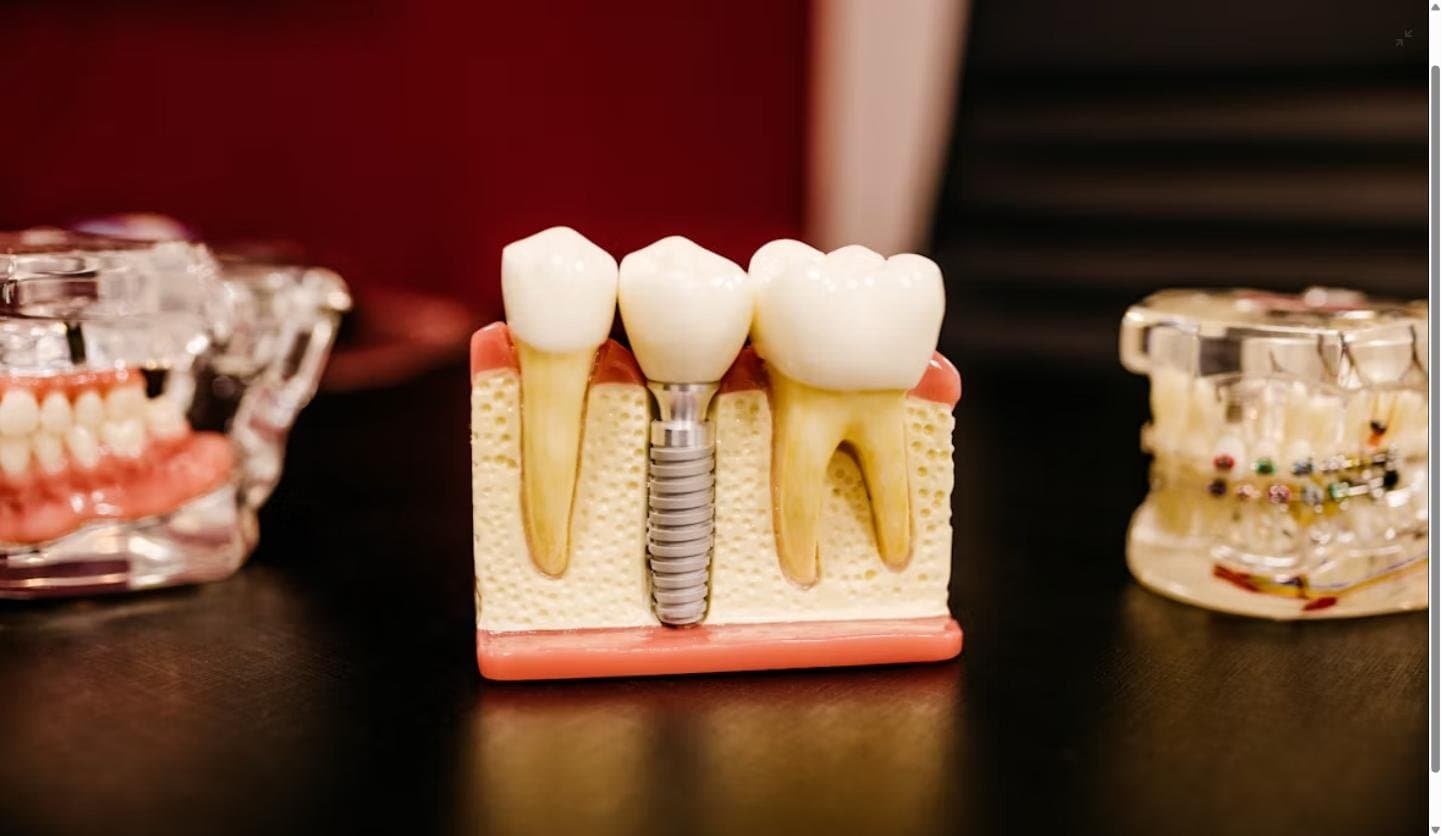 Cross-section model of a dental implant showing the titanium post placed in the jawbone between two natural teeth
