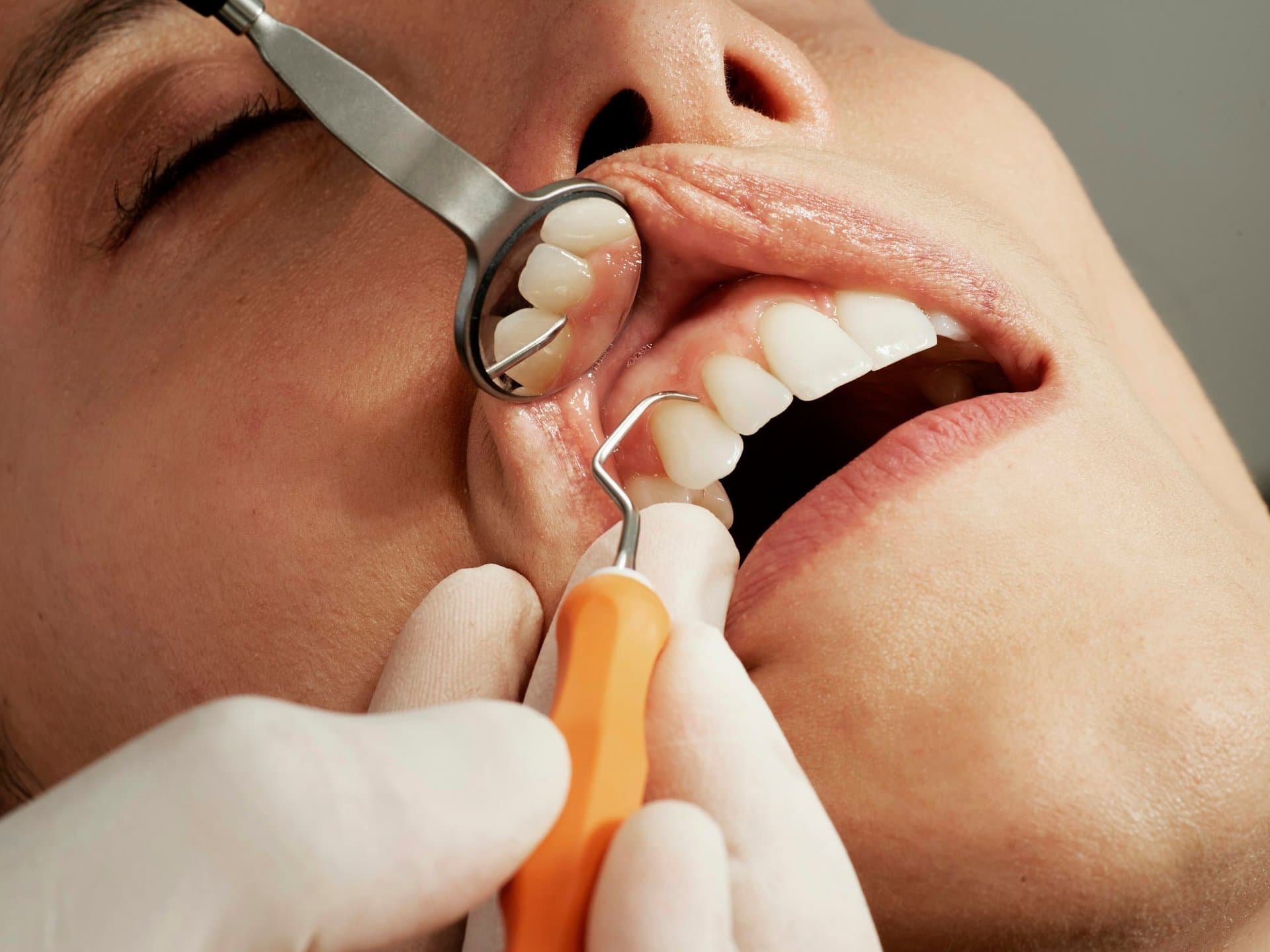 Close-up of a dentist examining a patient's teeth with a dental mirror and probe during a root canal consultation