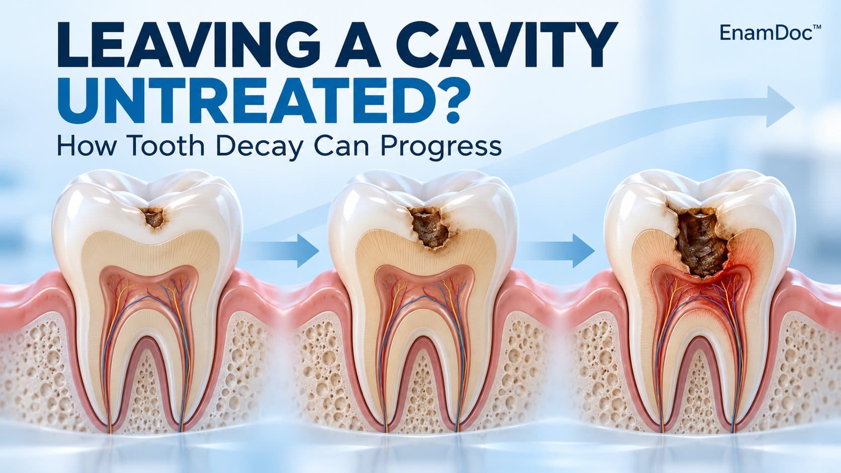 Three tooth cross-sections illustrating decay progressing from enamel through dentin toward the pulp.