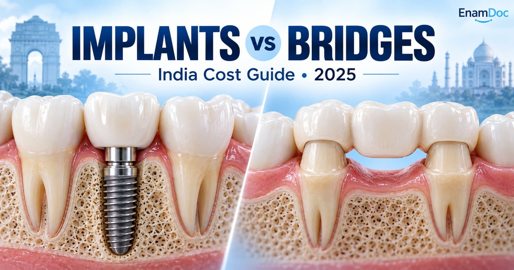 Side-by-side dental illustration of a single-tooth implant and a three-unit dental bridge.