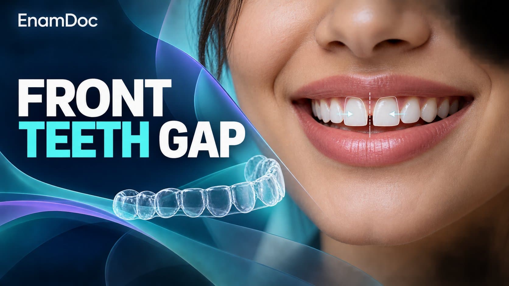 Close-up smile showing a gap between the upper front teeth beside a clear dental aligner.