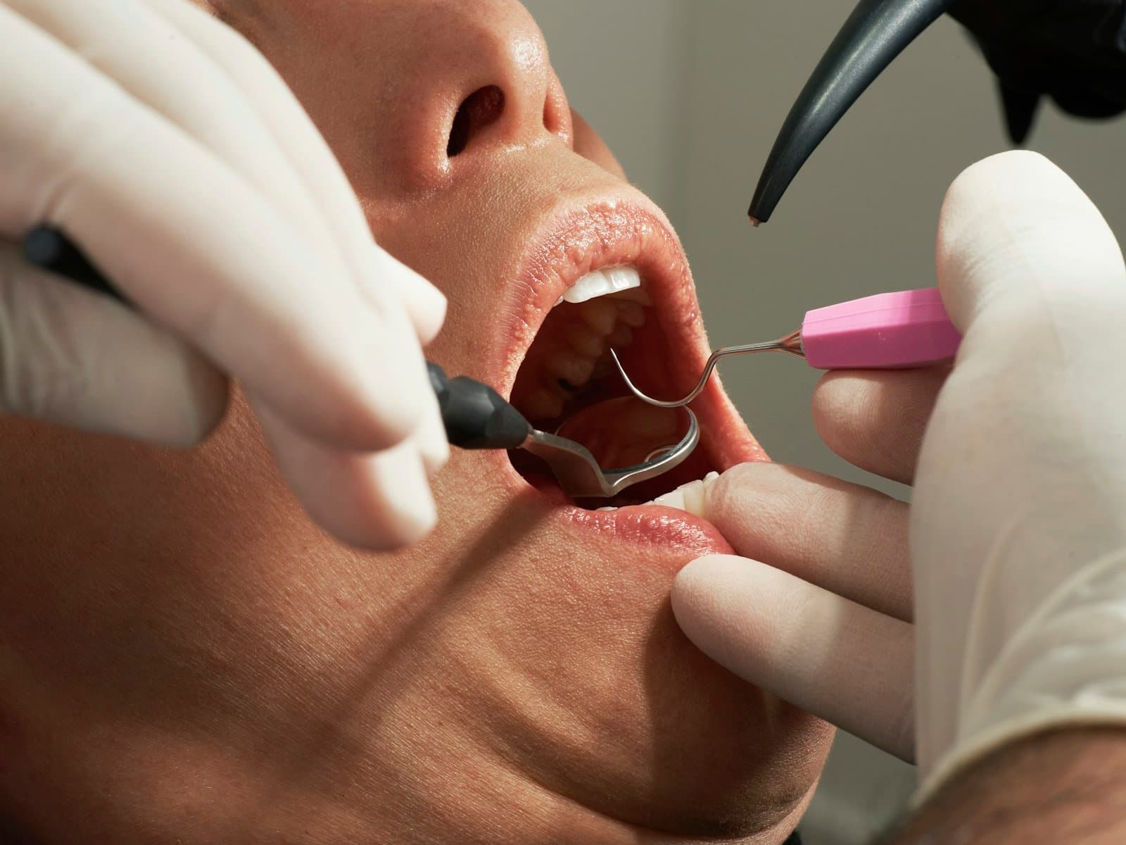 Close-up clinical photo of a dental exam of the gums and teeth, illustrating a gum health check relevant to gum depigmentation