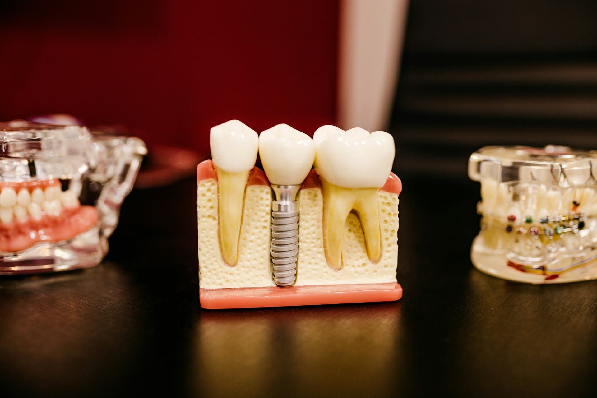 Close-up of a dental implant model showing the titanium implant post placed between two natural tooth models