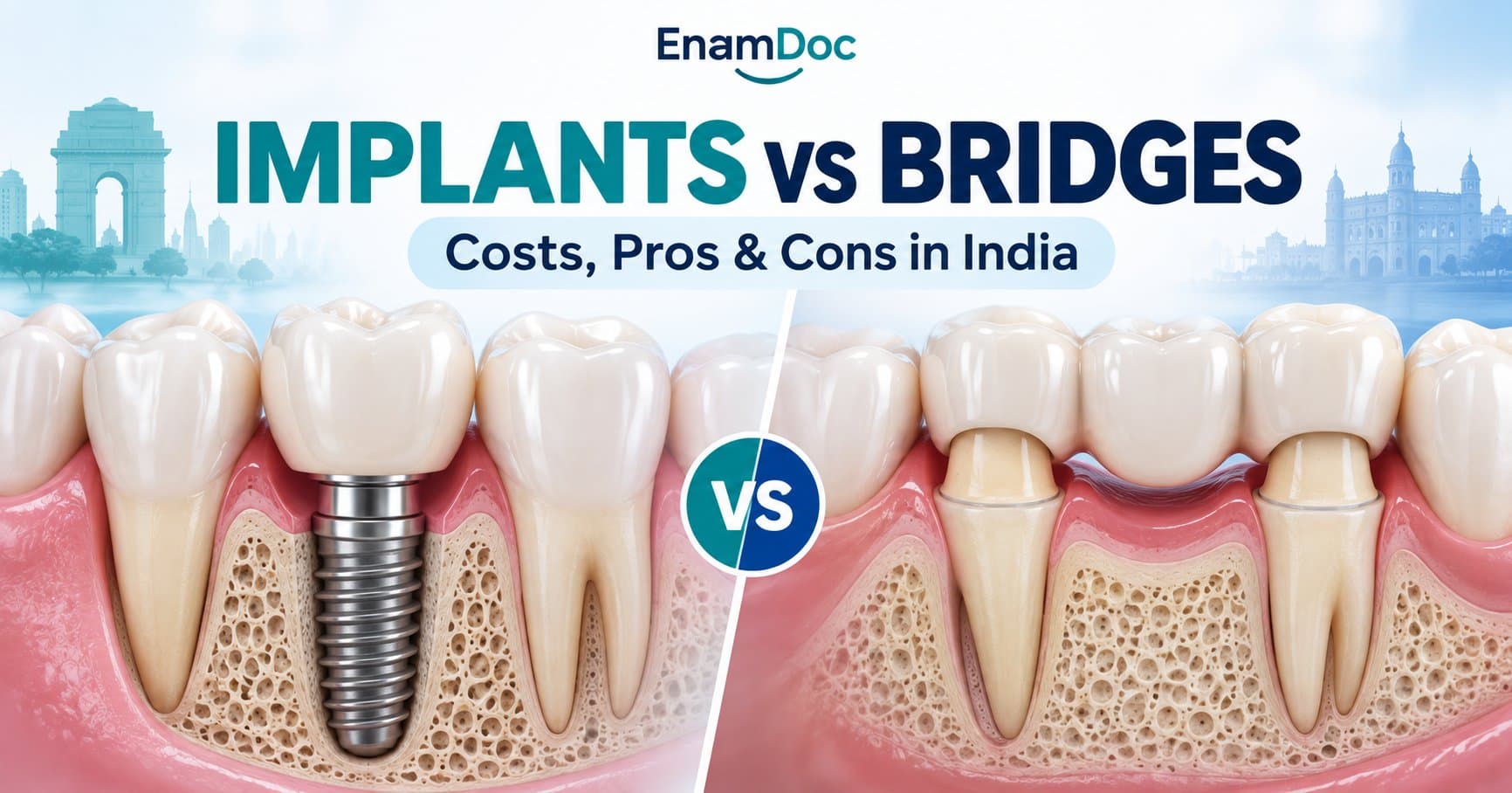 Side-by-side dental illustration comparing a single-tooth implant with a three-unit bridge.