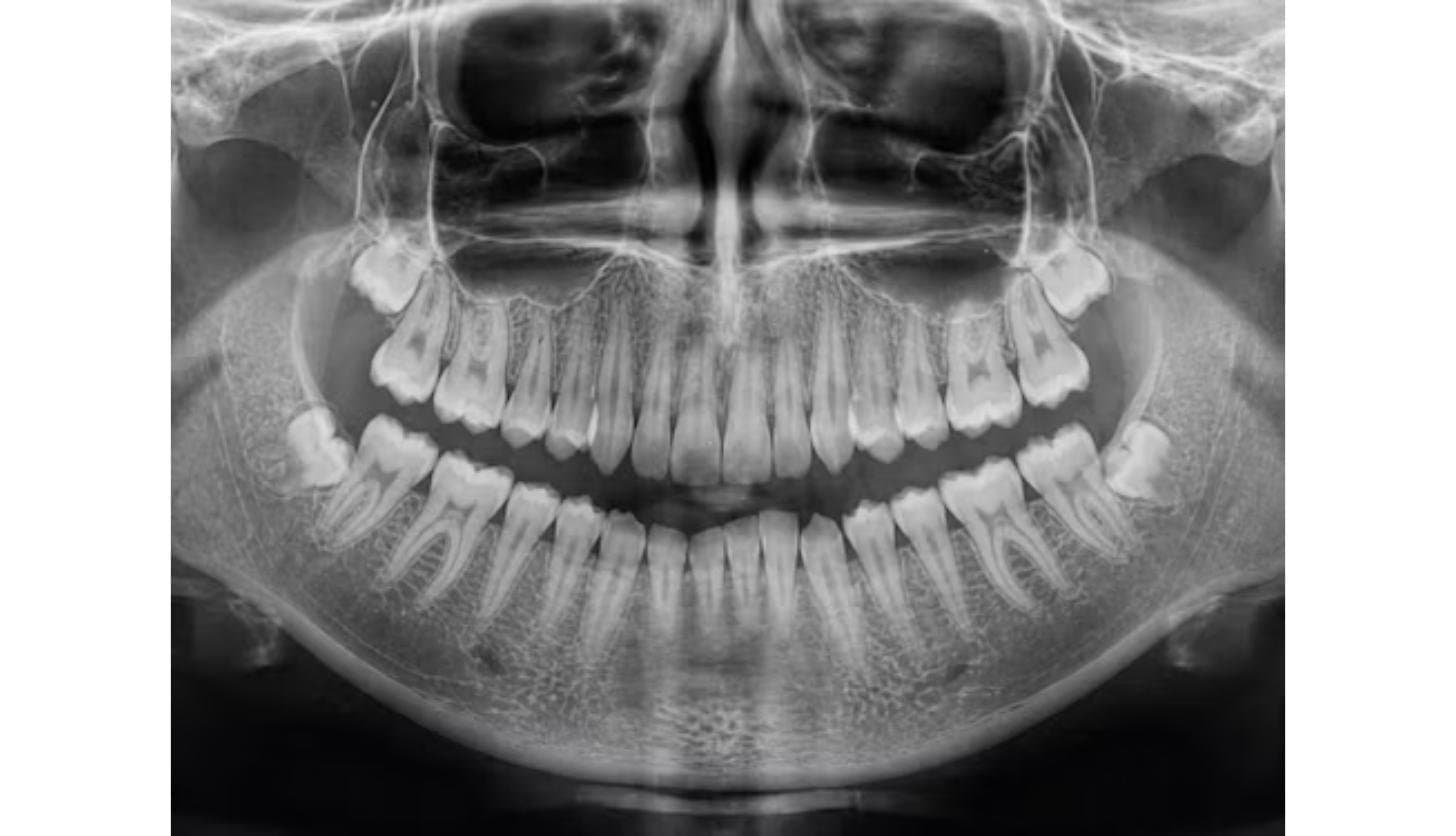 Panoramic dental X-ray showing impacted wisdom teeth used to assess angulation and depth